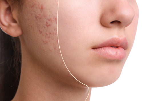 What's the best way to treat and prevent acne?
